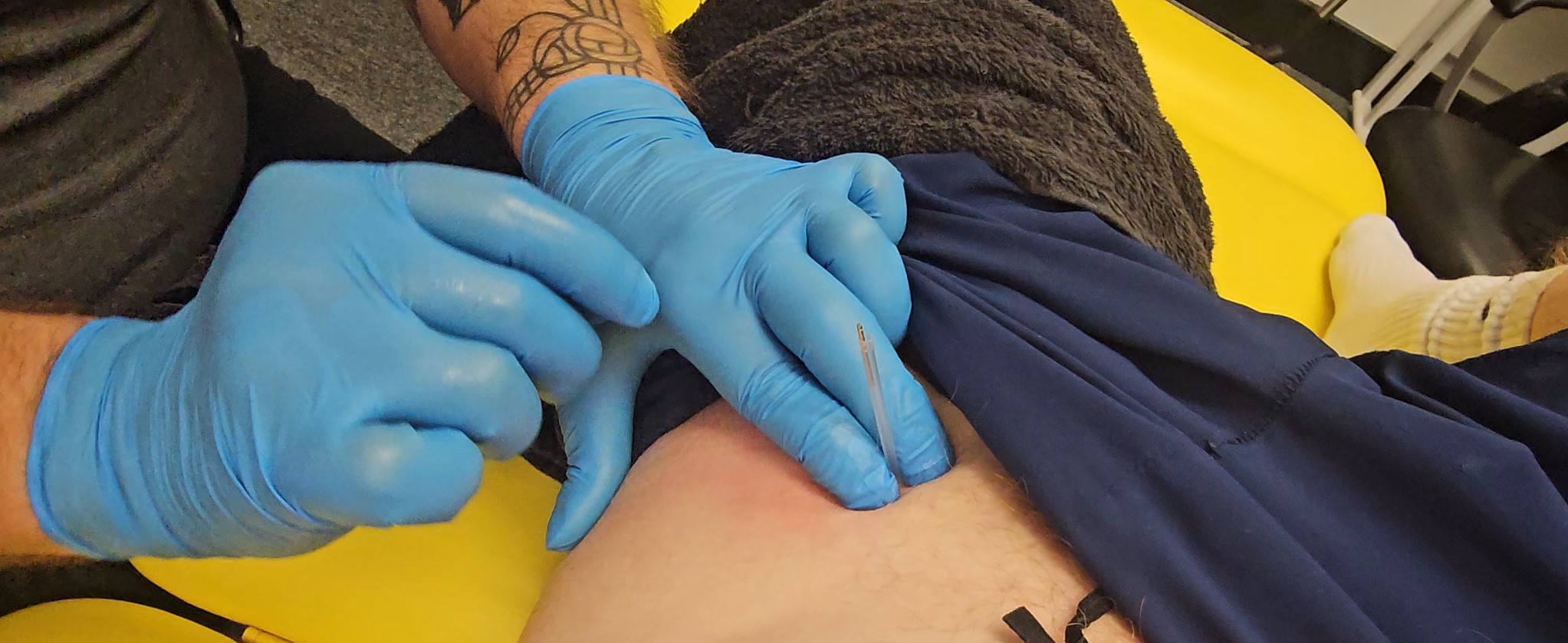 Acupuncture dry needling treatment at Glasgow Sport & Spine Clinic